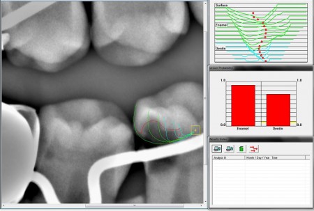 cavity-detection-software