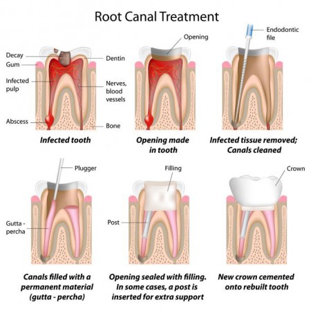 get a root canal from our Fulshear dentist to relieve tooth pain