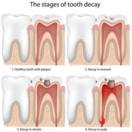we provide composite fillings to treat cavities at our Katy dentist