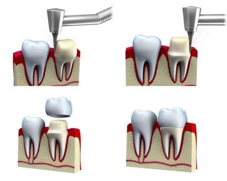 get dental crowns to restore your smile from your Katy dentist